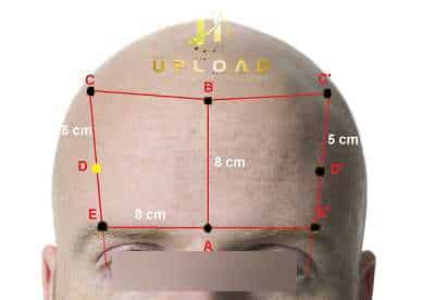 Natural Hairline Design: Guide for Men & Women 8 frontal-hair-line-hair-transplant-2