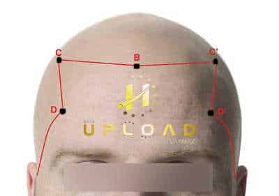 Natural Hairline Design: Guide for Men & Women 9 frontal-hair-line-hair-transplant