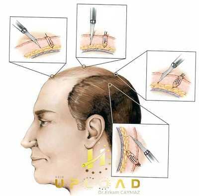 hair-angles_10 Hair transplant angles
