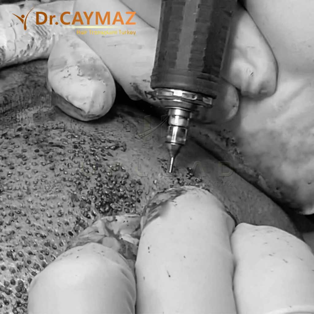 Hair Transplant Process 6 hair-extraction