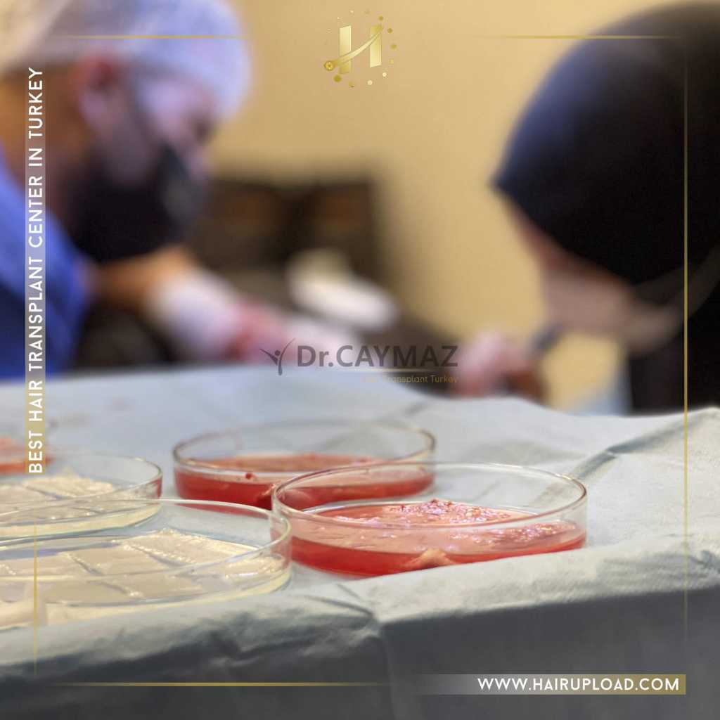 Can FUE Hair Transplantation Fail? 1 hair-graft-35.jpg