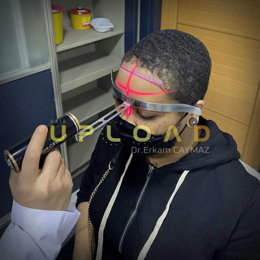 hair-line-design-dr-caymaz Laser Hair Line