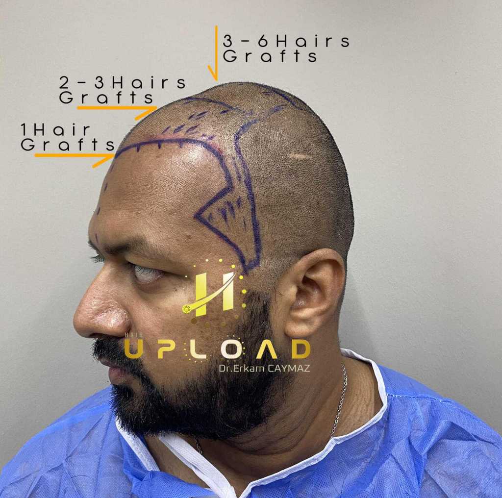Natural Hairline Design: Guide for Men & Women 5 1 hair how much graft