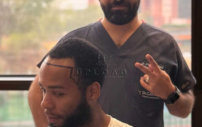 Hair Upload - Hair Transplant Turkey – Istanbul - 2026 12 happy-patients