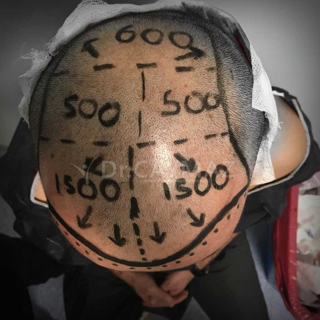 Norwood Savin Hair Loss Scale 3 This case is not a perfect density.