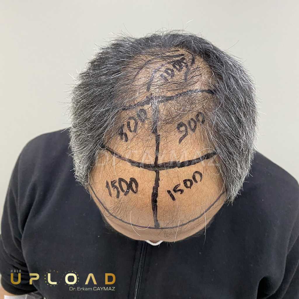 Hair Transplant Process 21 how many hair