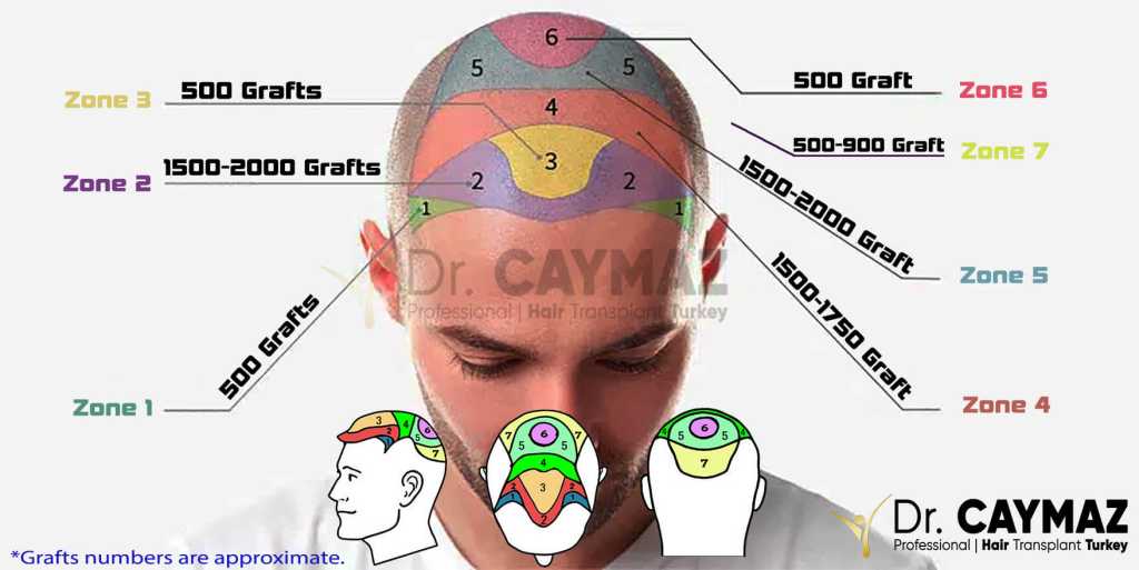 Why is the Density Important in Hair Transplantation and How Should the Density Be? 5 Why density is important for hair transplant?