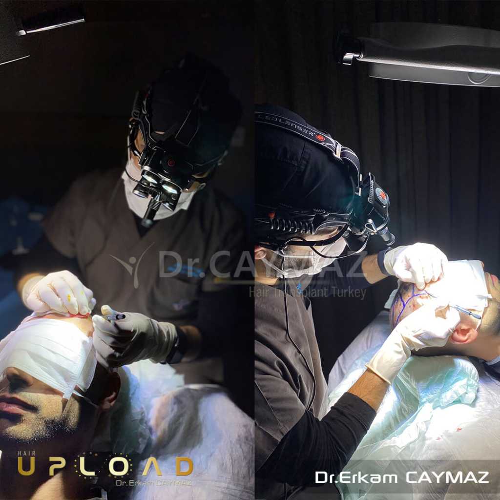Hair Transplant Process 10 sapphire fue hair transplant