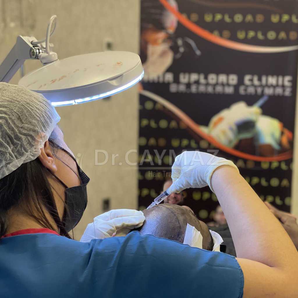Hair Transplant Process 20 needle-local-anesthesia