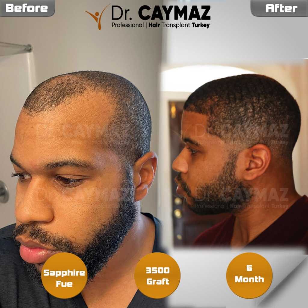 Afro Hair Transplant: How Curl Geometry Changes FUE Graft Planning 1 Afro Hair Transplant: How Curl Geometry Changes FUE Graft Planning