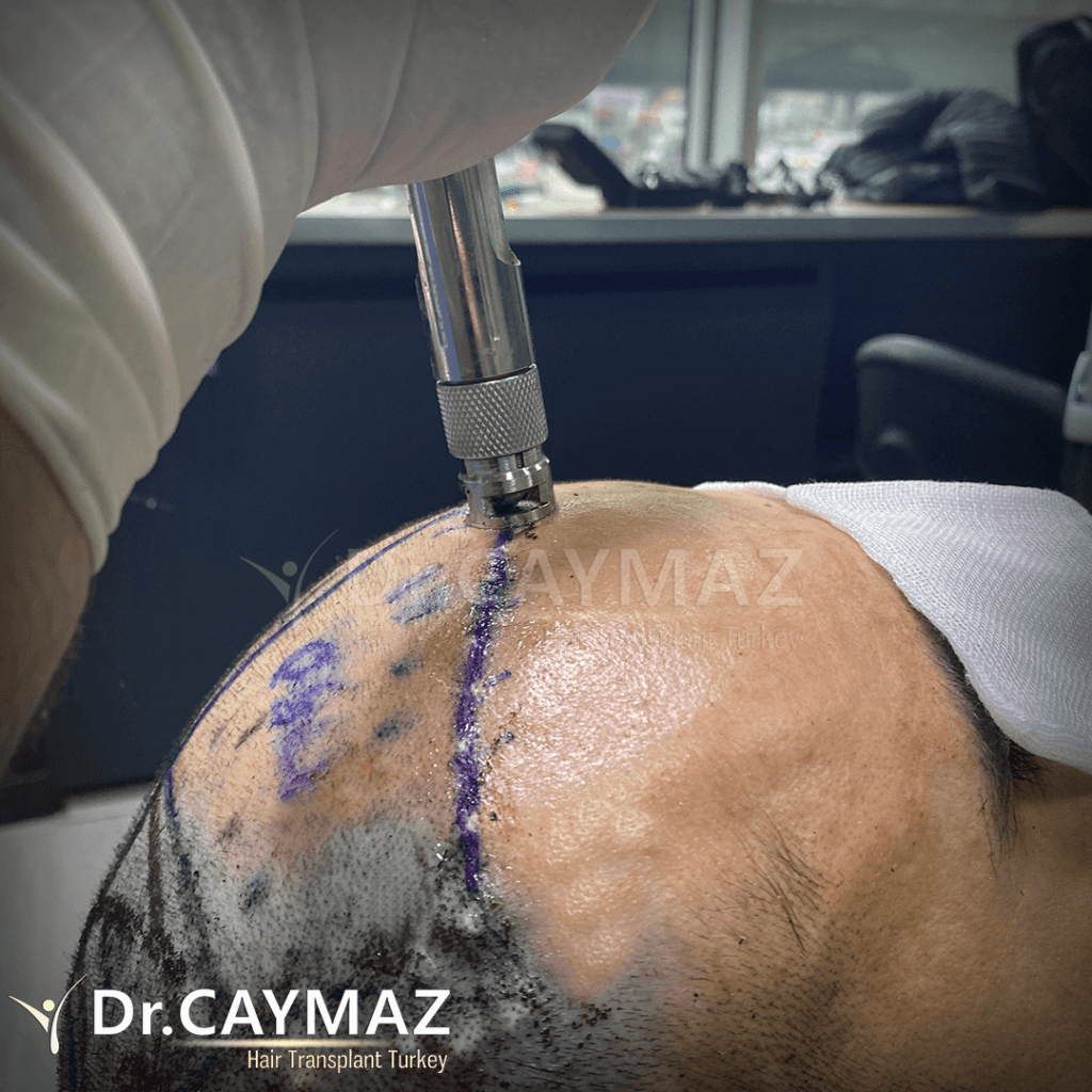 Hair Transplant Process 19 painless anesthesia