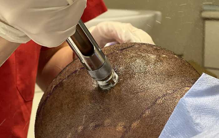 Hair Upload - Hair Transplant Turkey – Istanbul - 2026 12 painless anesthesia 1