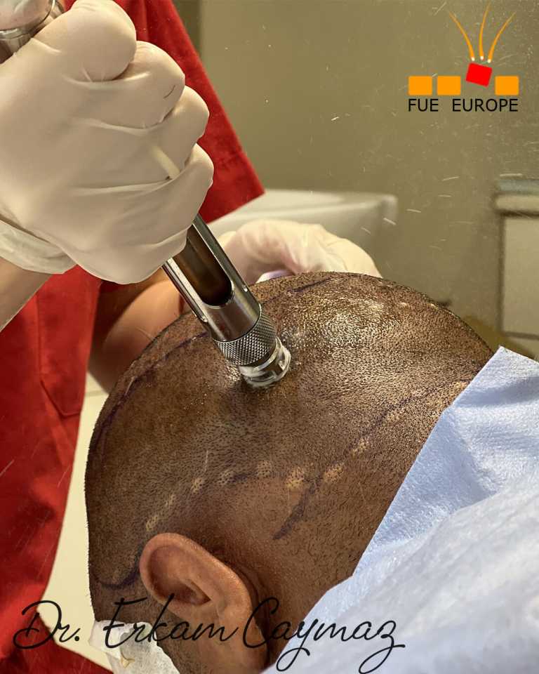 painless anesthesia 1