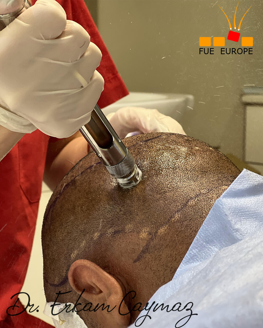 painless anesthesia 1
