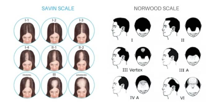 Norwood Savin Hair Loss Scale Norwood Savin Hair Loss Scale