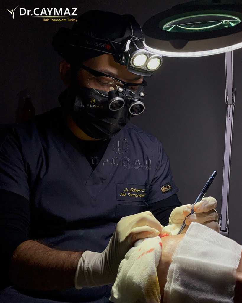 Finasteride and Hair Transplant: Optimising Results and Safety 1 Finasteride and Hair Transplant: Optimising Results and Safety
