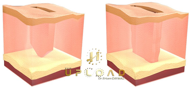 Sapphire Fue Hair Transplantation 3 Sapphire Fue vs Classic Fue