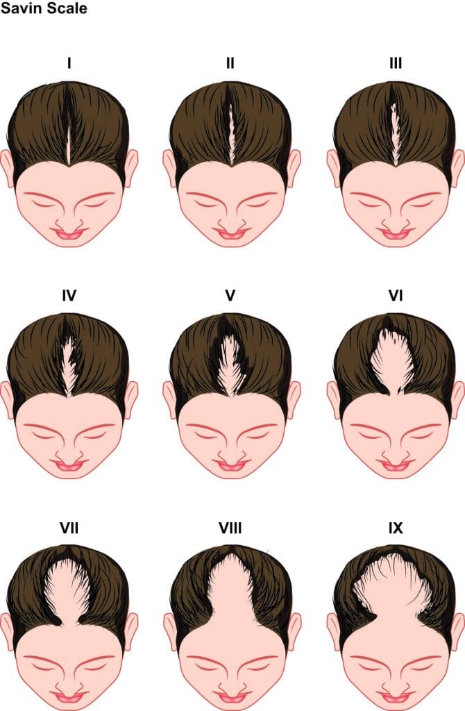 Norwood Savin Hair Loss Scale Norwood Savin Hair Loss Scale