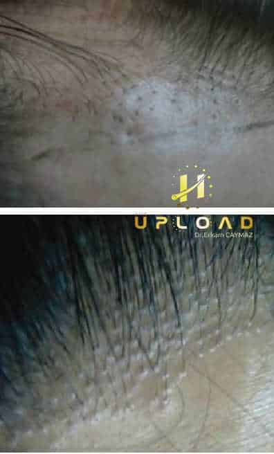 side-effect-3 Side Effects of Hair Transplantation